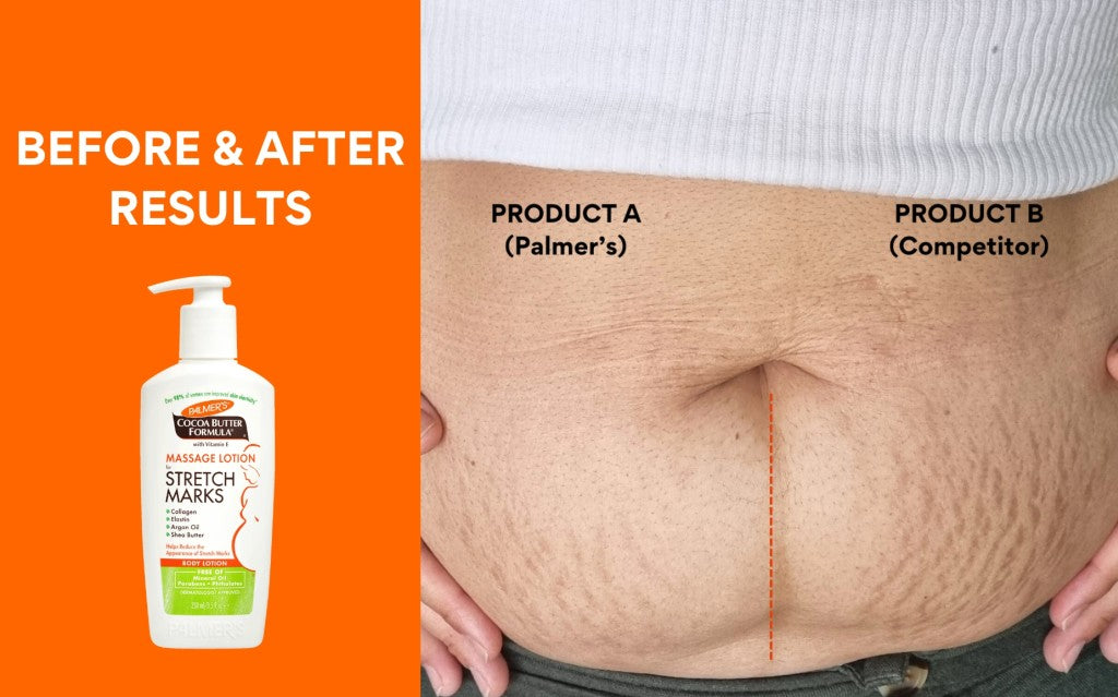 woman with stretch marks and results after using palmers