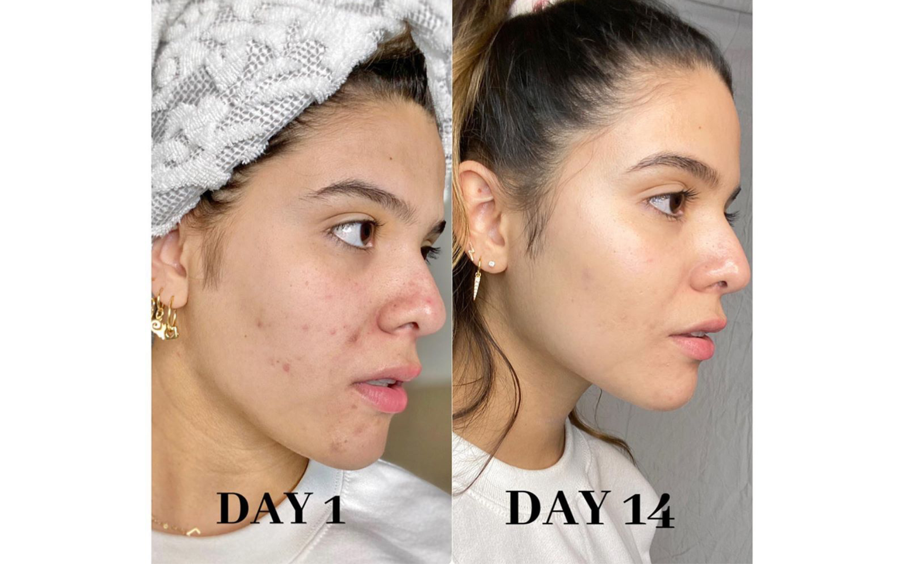 before and after results using skin success